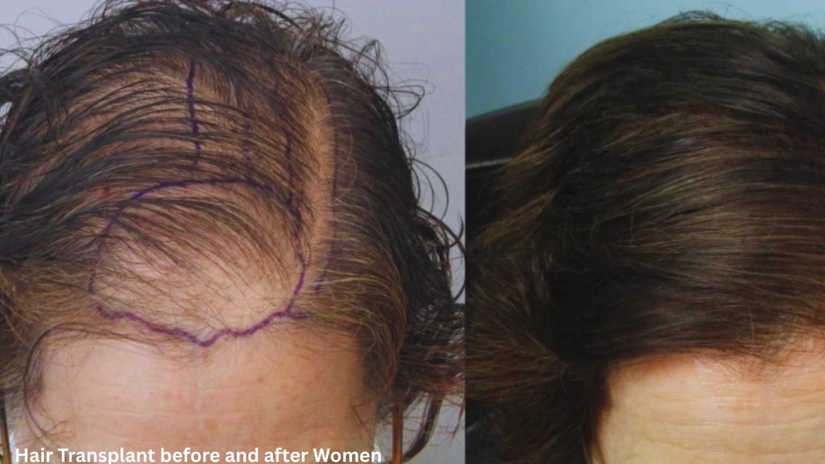 Hair Transplant before and after Women