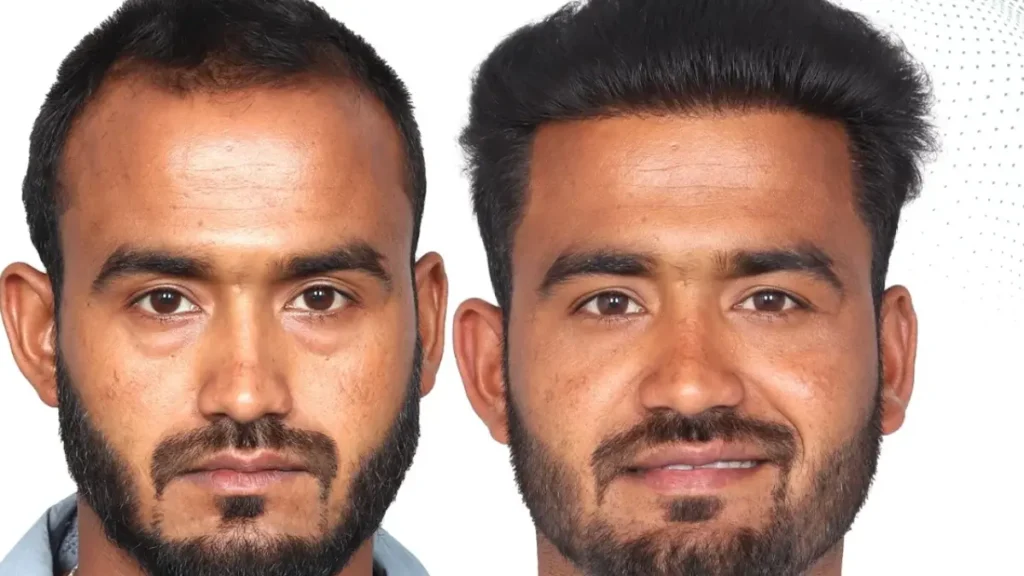 Beard Hair Transplant in Chennai Beard Hair Transplant in Chennai