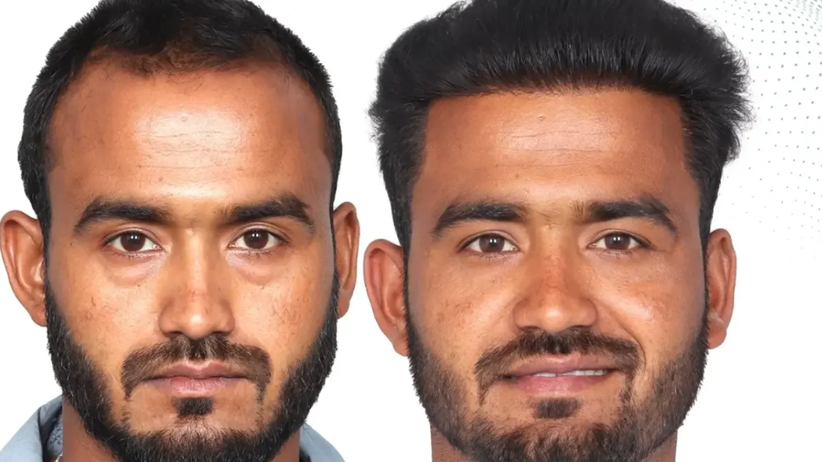 Beard Hair Transplant in Chennai
