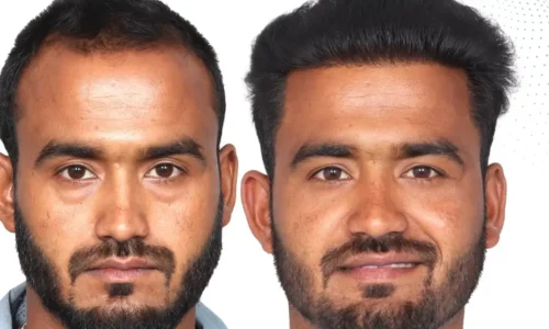 Beard Hair Transplant in Chennai