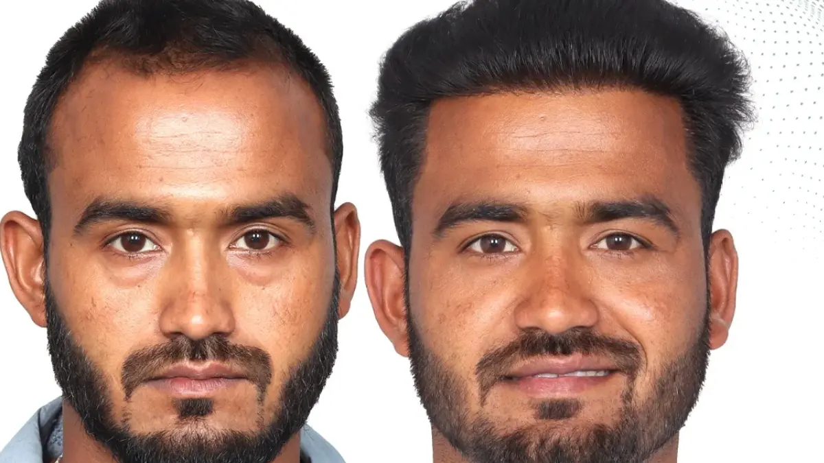 Beard Hair Transplant in Chennai