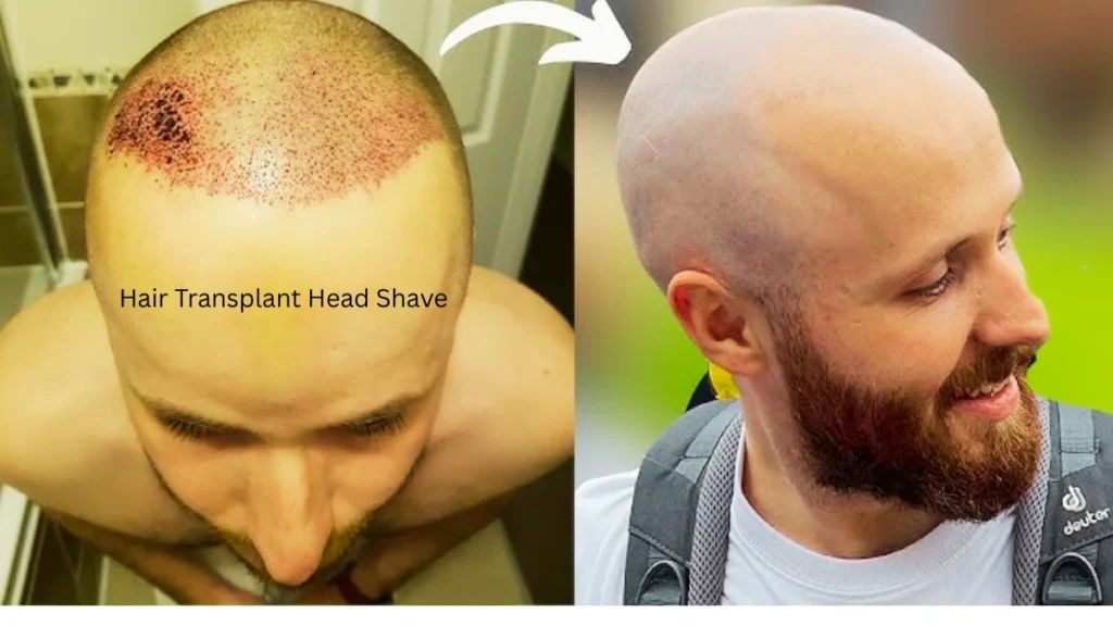 Hair Transplant Head Shave Hair Transplant Head Shave