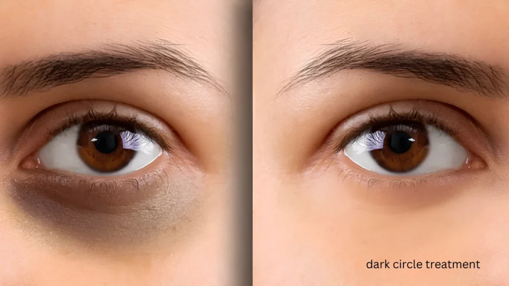 dark circle treatment dark circle treatment